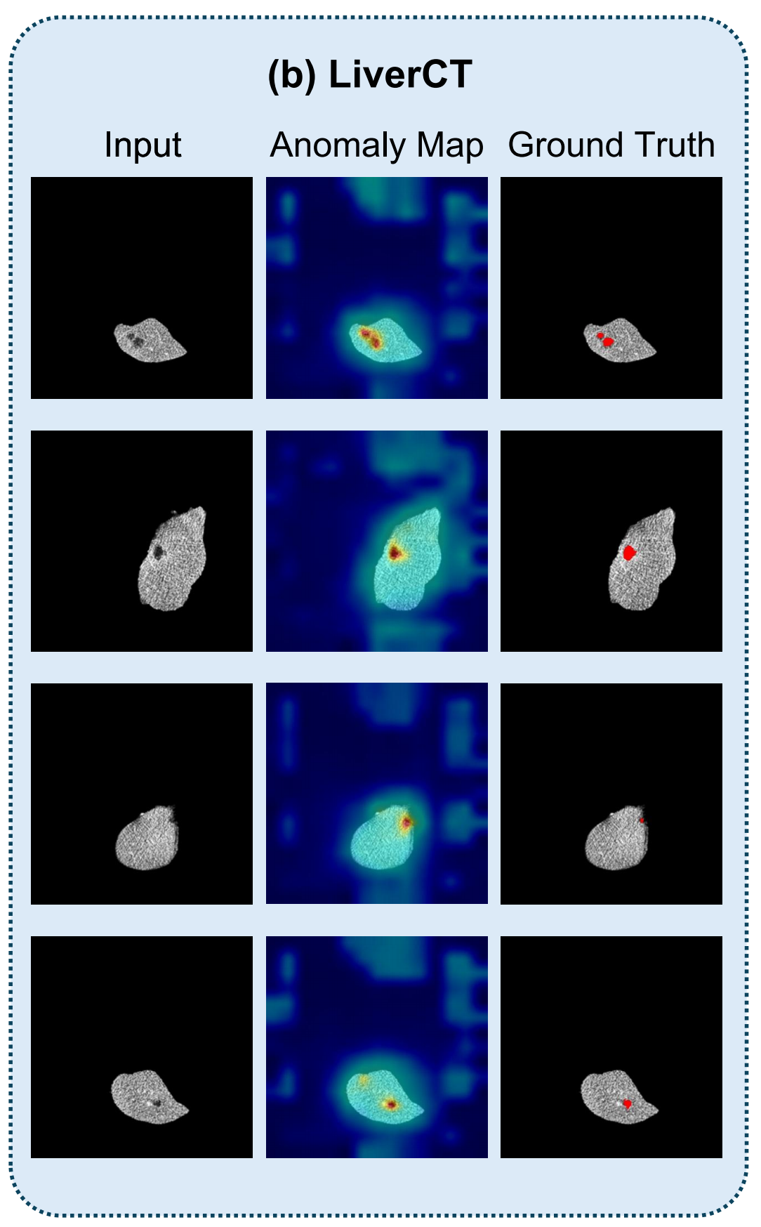 Medical Anomaly Rip Few-shot Medical Anomaly Detection through Centroid Consultation Back ...